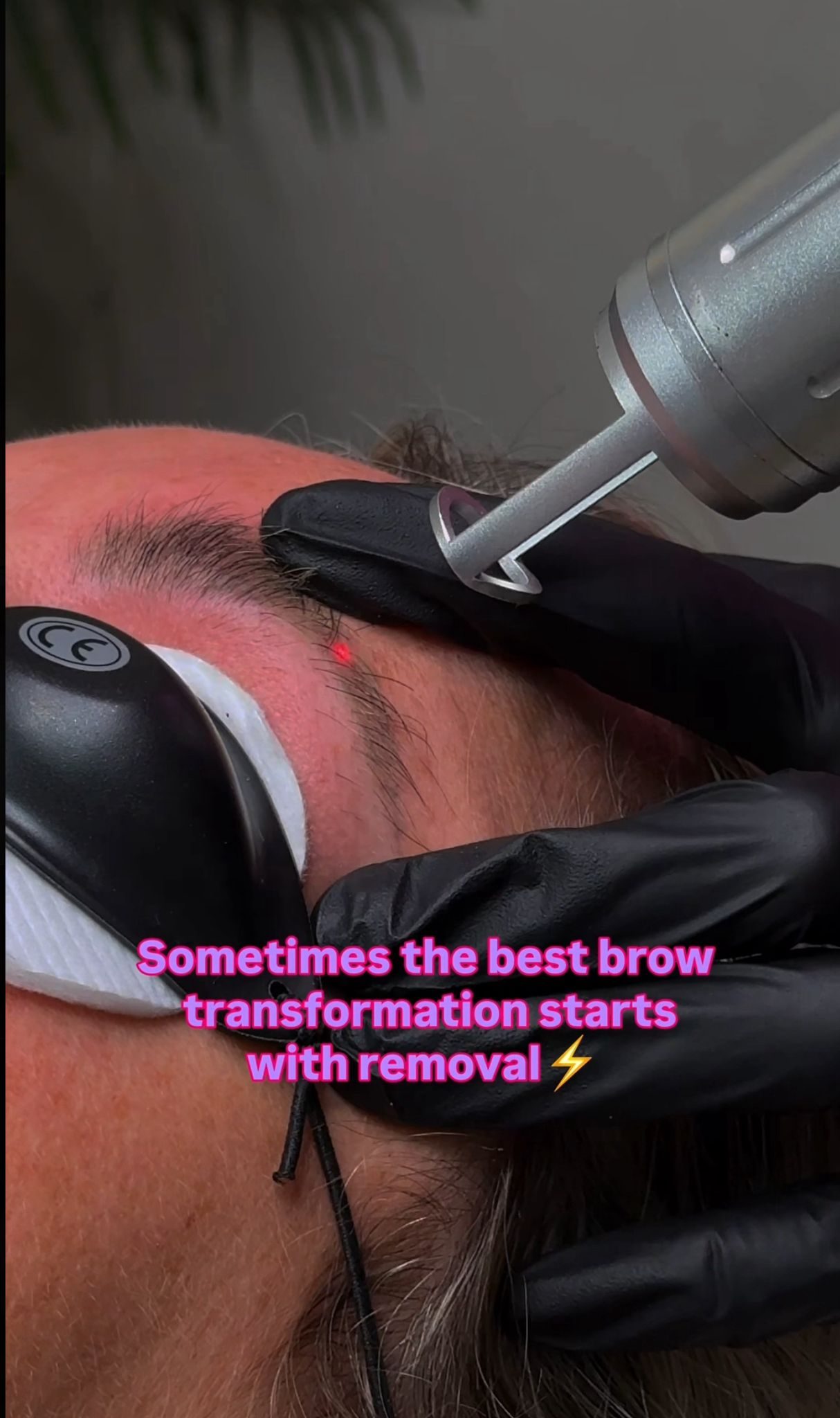 Laser brow tattoo removal treatment in progress, Liverpool